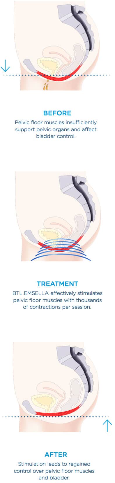 Before pelvic bladder control affected, Treatment stimulate muscle, After regained bladder control