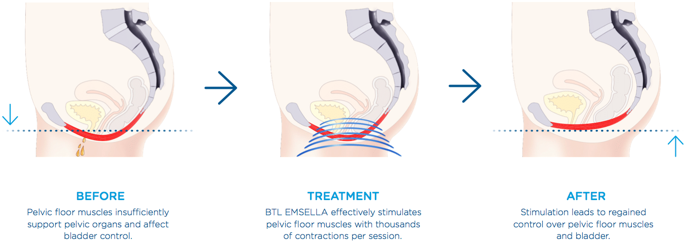 Before pelvic floor muscle affect bladder control, Treatment stimulate muscle, After regain control