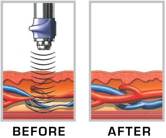 Veins before and after Low Intensity Shockwave Therapy